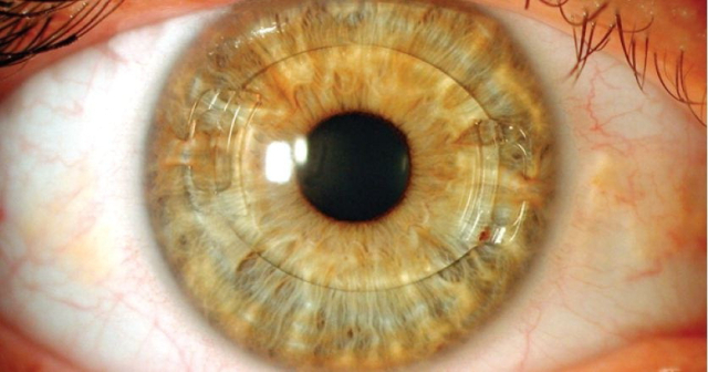 사진은 각막과 홍채 사이에 알티플러스 렌즈를 삽입한 모습. 눈시원안과의원 제공
